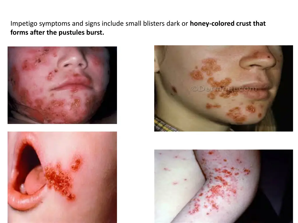 impetigo symptoms and signs include small