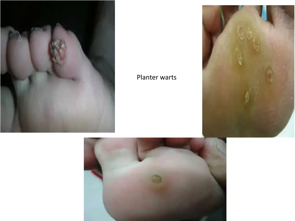 planter warts