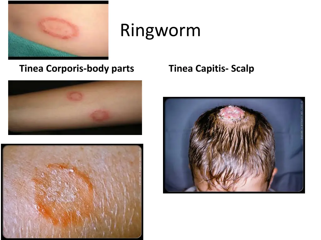 ringworm 1