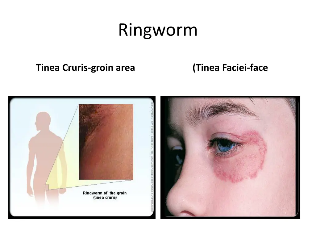 ringworm 2