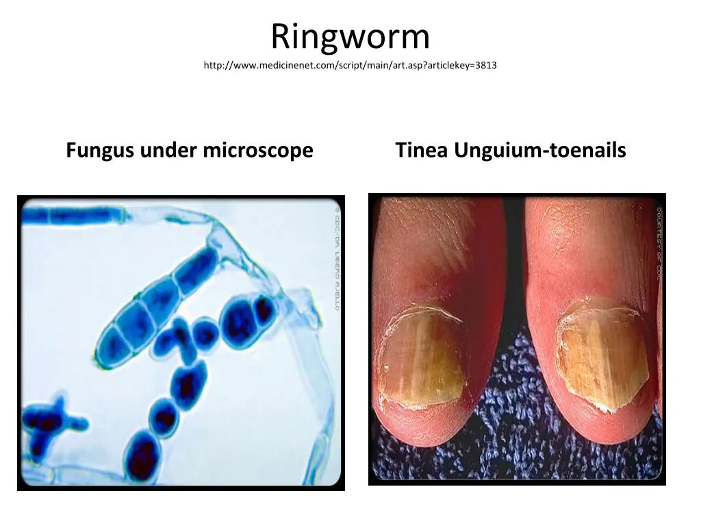 ringworm http www medicinenet com script main