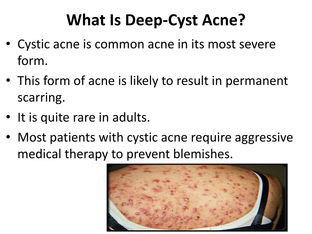 what is deep cyst acne cystic acne is common acne