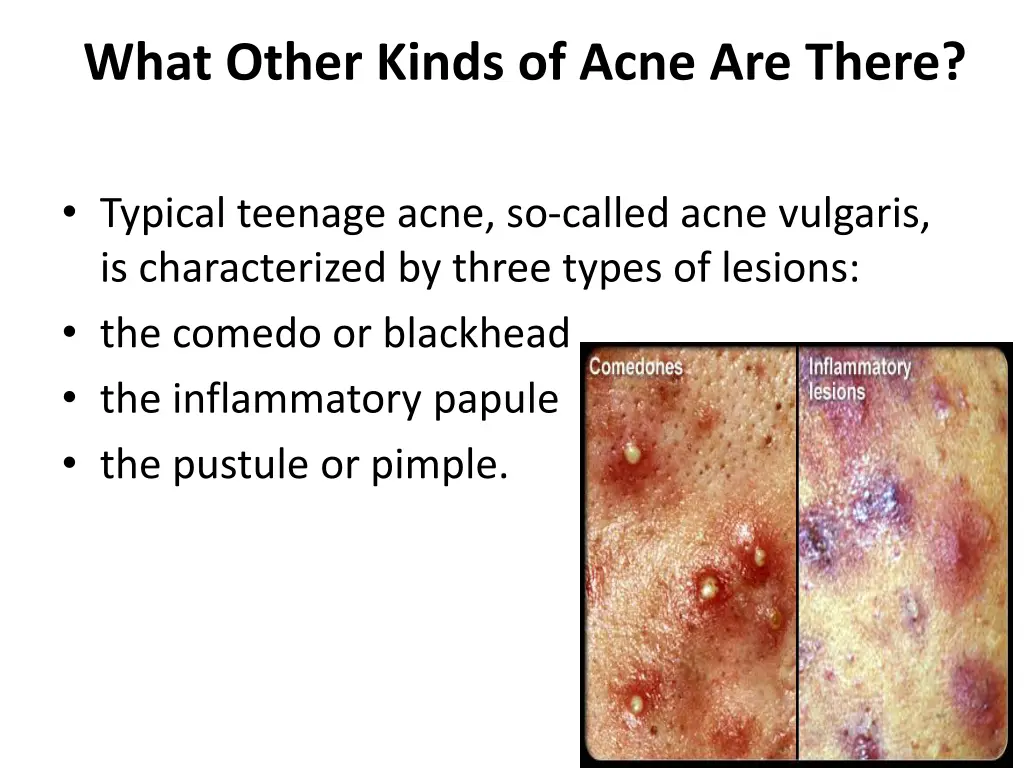 what other kinds of acne are there