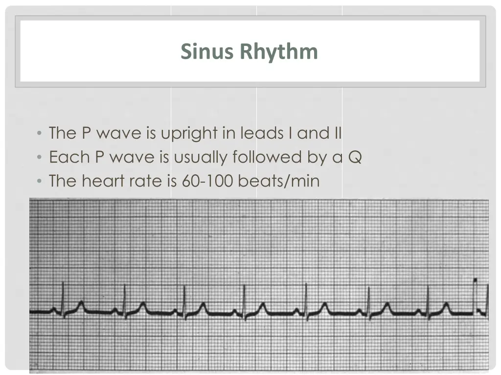 sinus rhythm