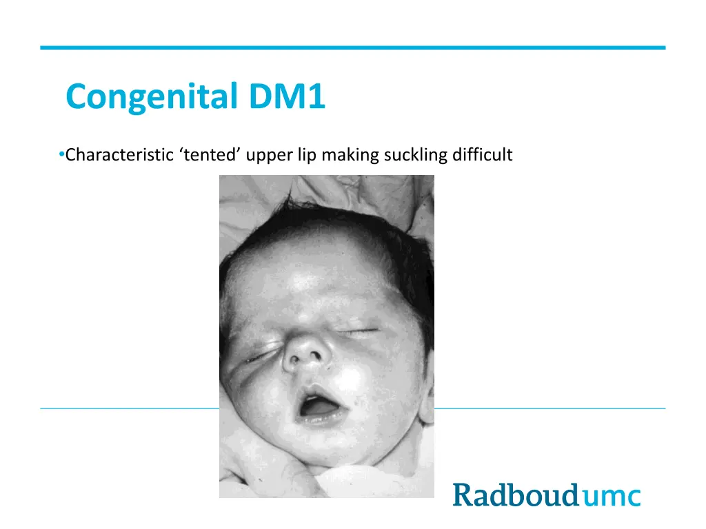 congenital dm1 1