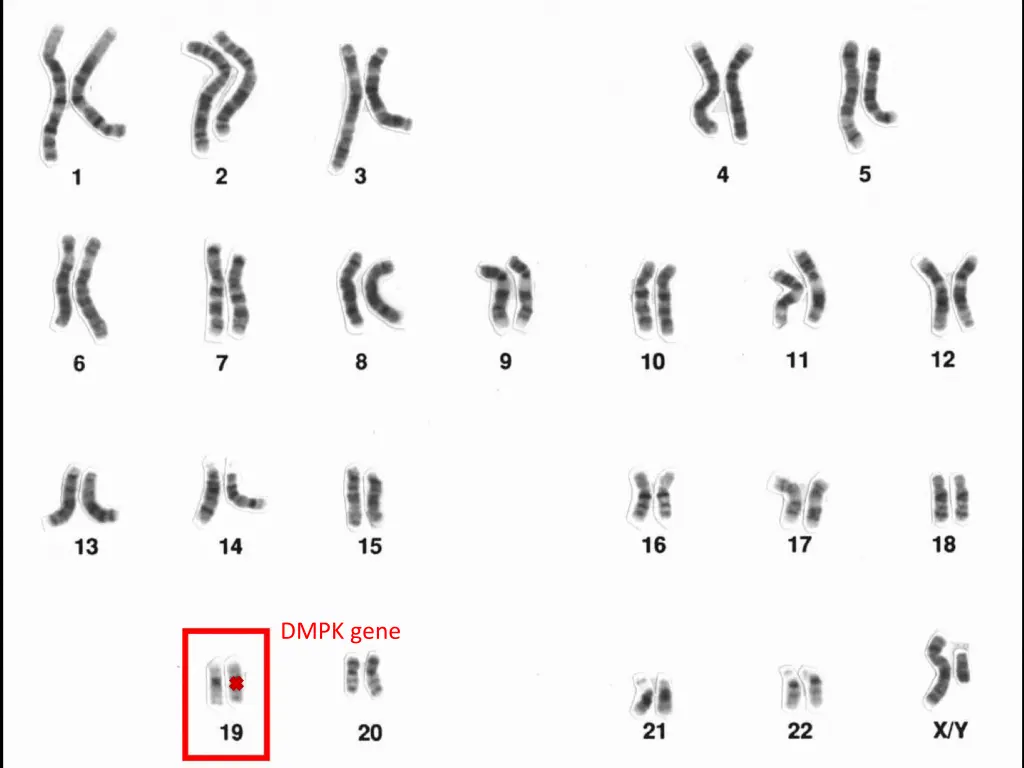 dmpk gene