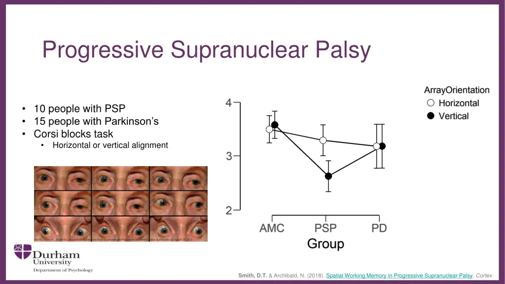 progressive supranuclear palsy