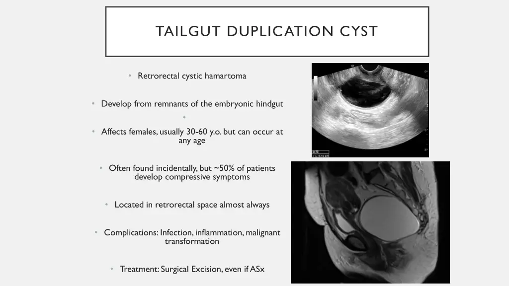 tailgut duplication cyst