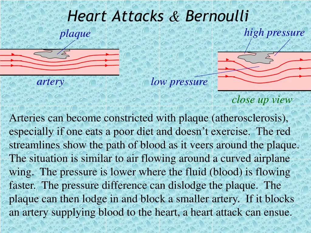 heart attacks bernoulli plaque