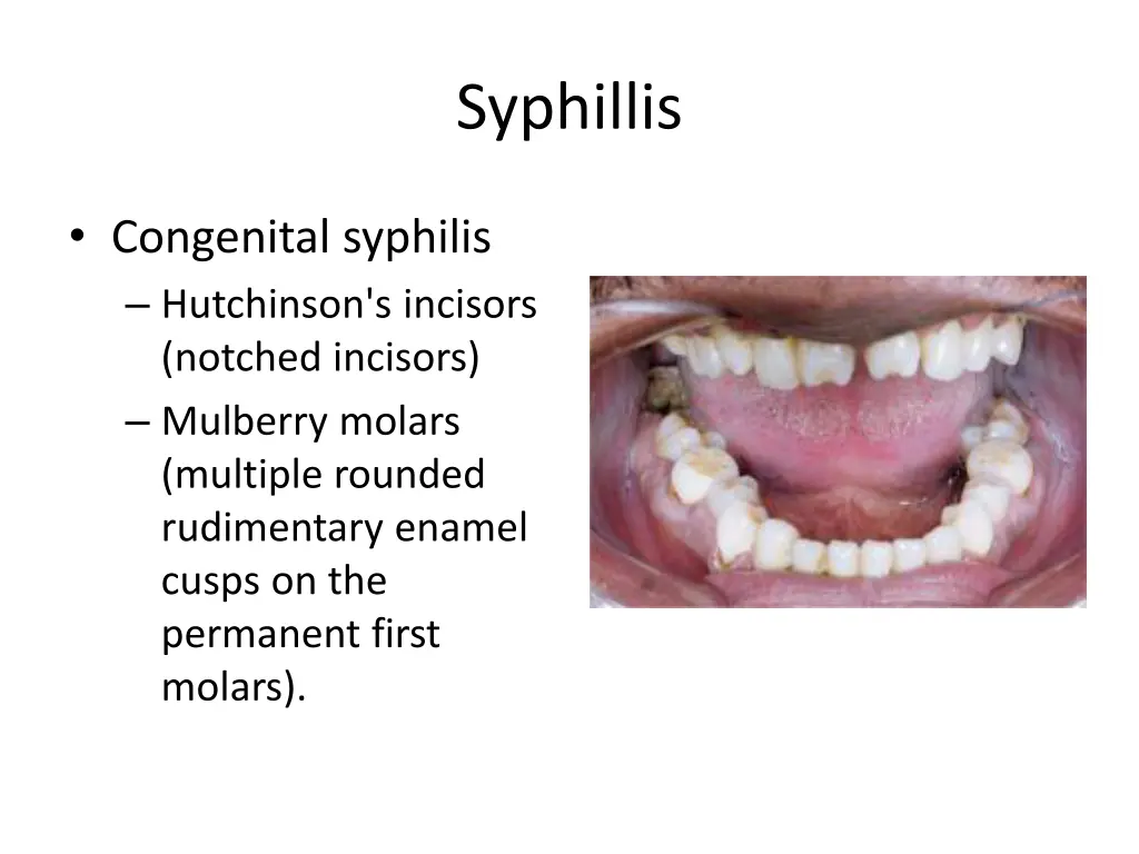 syphillis