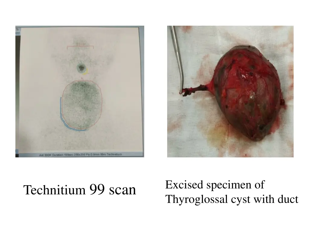 excised specimen of thyroglossal cyst with duct