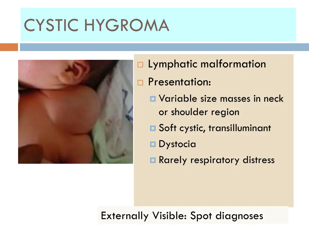 cystic hygroma