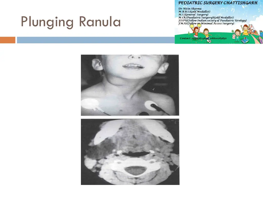 plunging ranula 1