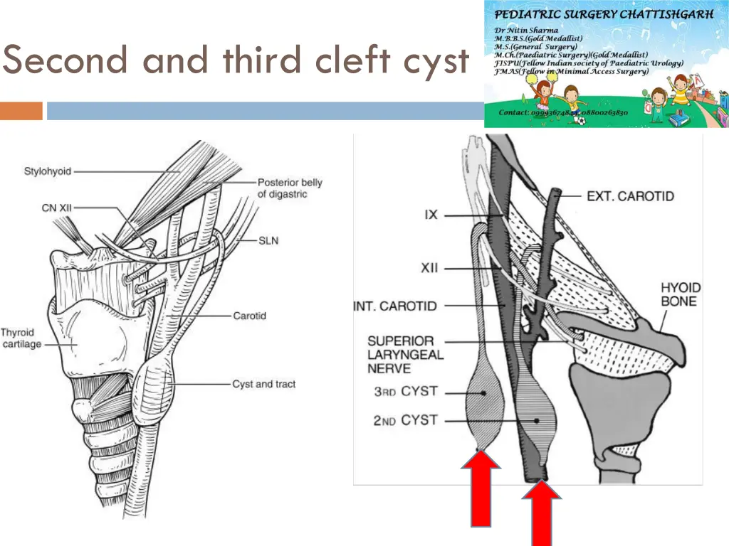 second and third cleft cyst