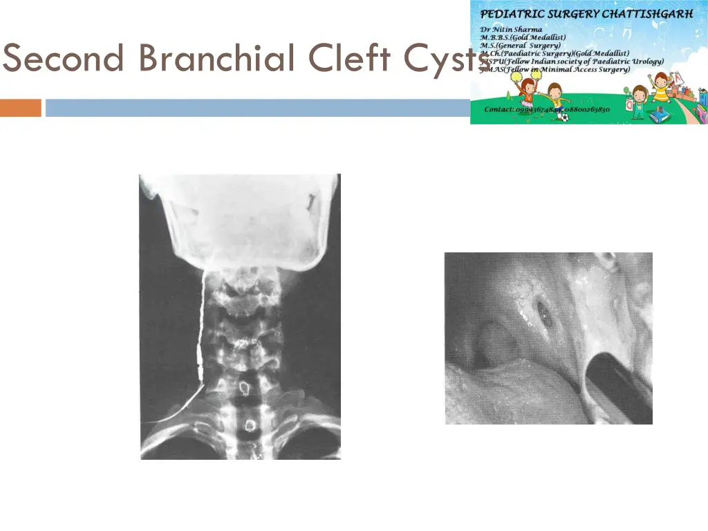 second branchial cleft cysts 1