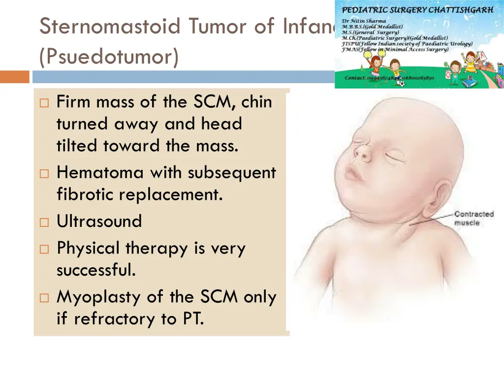 sternomastoid tumor of infancy psuedotumor