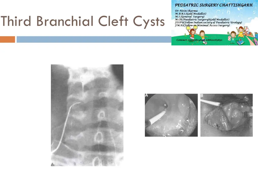 third branchial cleft cysts 1