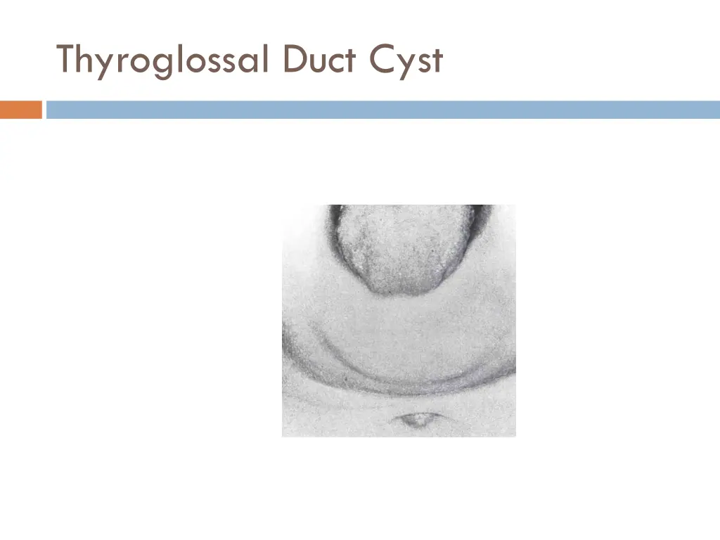 thyroglossal duct cyst 1