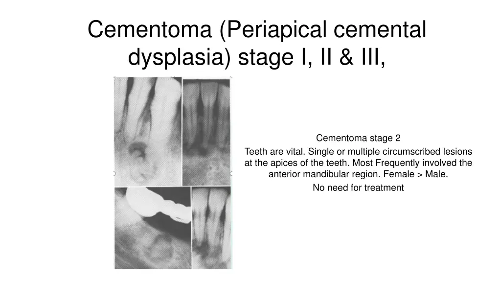 cementoma periapical cemental dysplasia stage 1