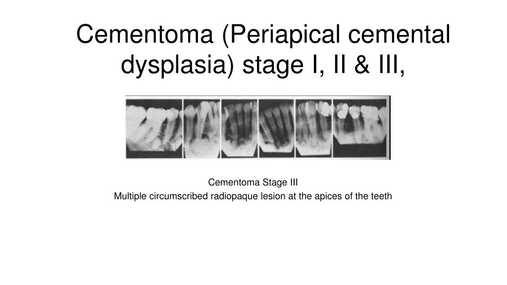 cementoma periapical cemental dysplasia stage 2