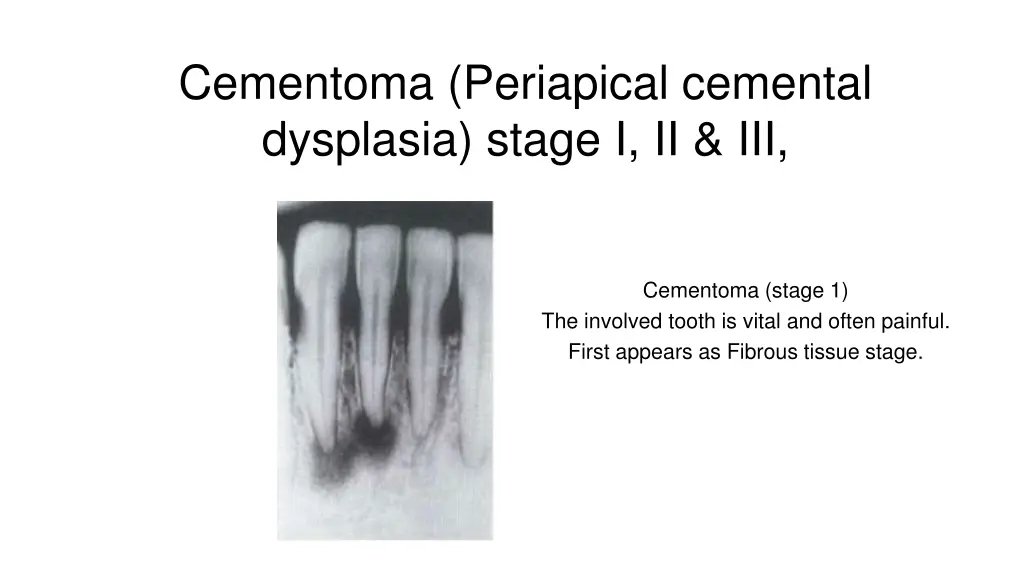 cementoma periapical cemental dysplasia stage