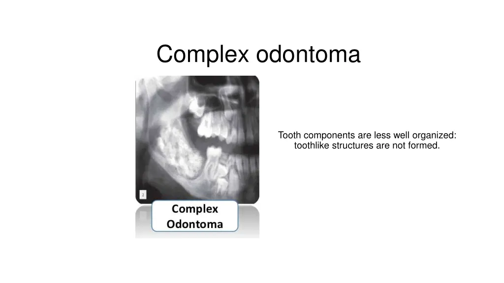 complex odontoma