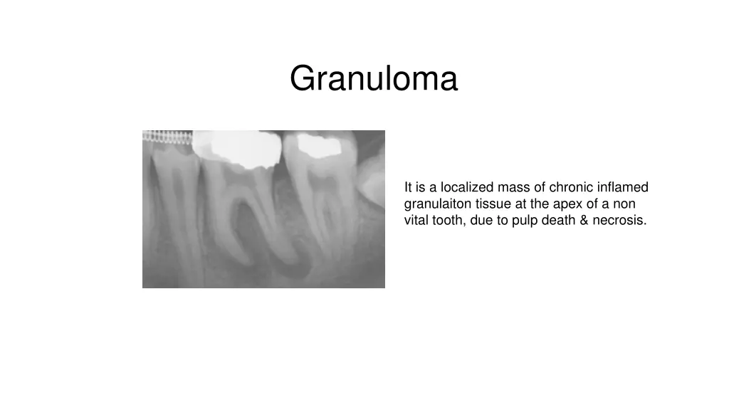 granuloma