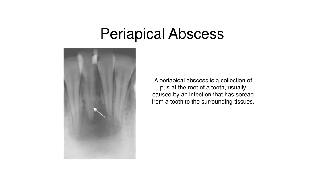 periapical abscess