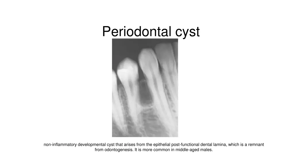 periodontal cyst