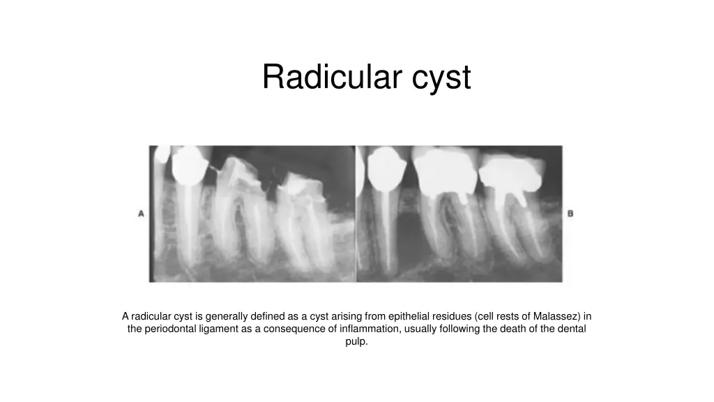 radicular cyst