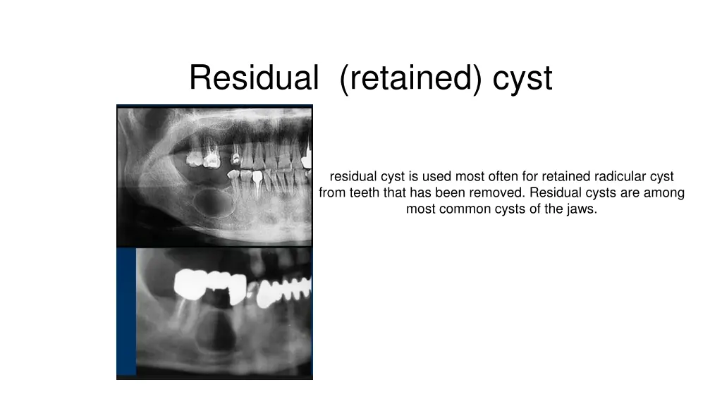 residual retained cyst