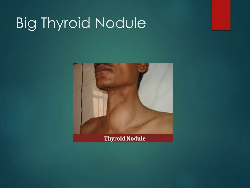 big thyroid nodule