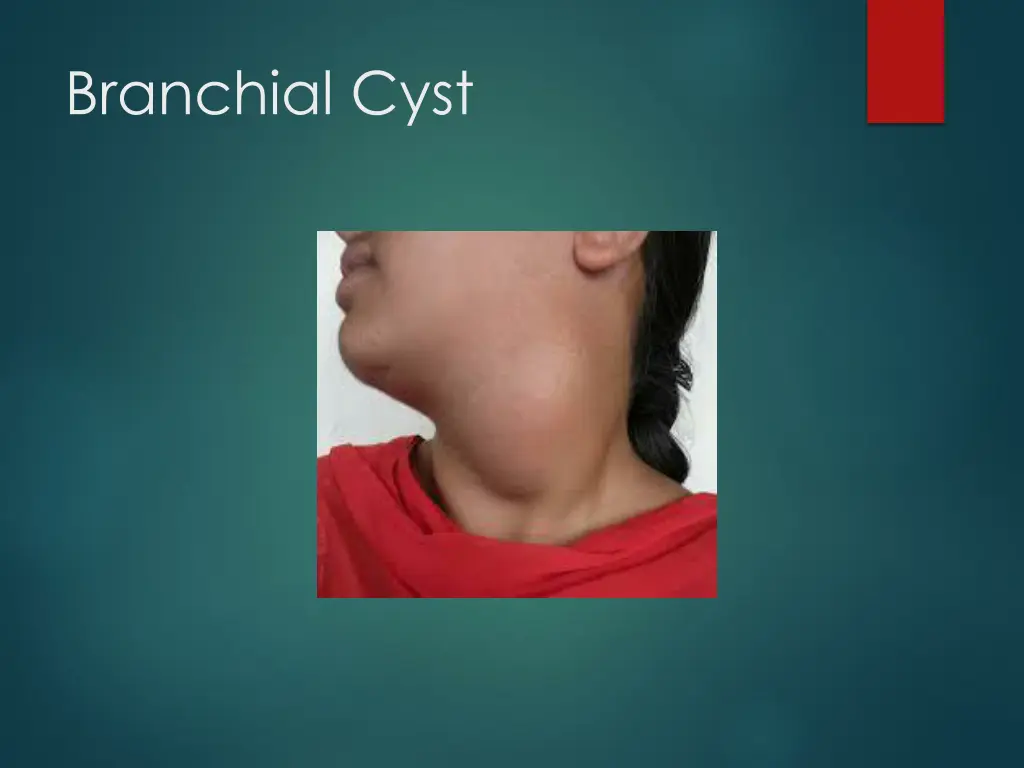 branchial cyst 2