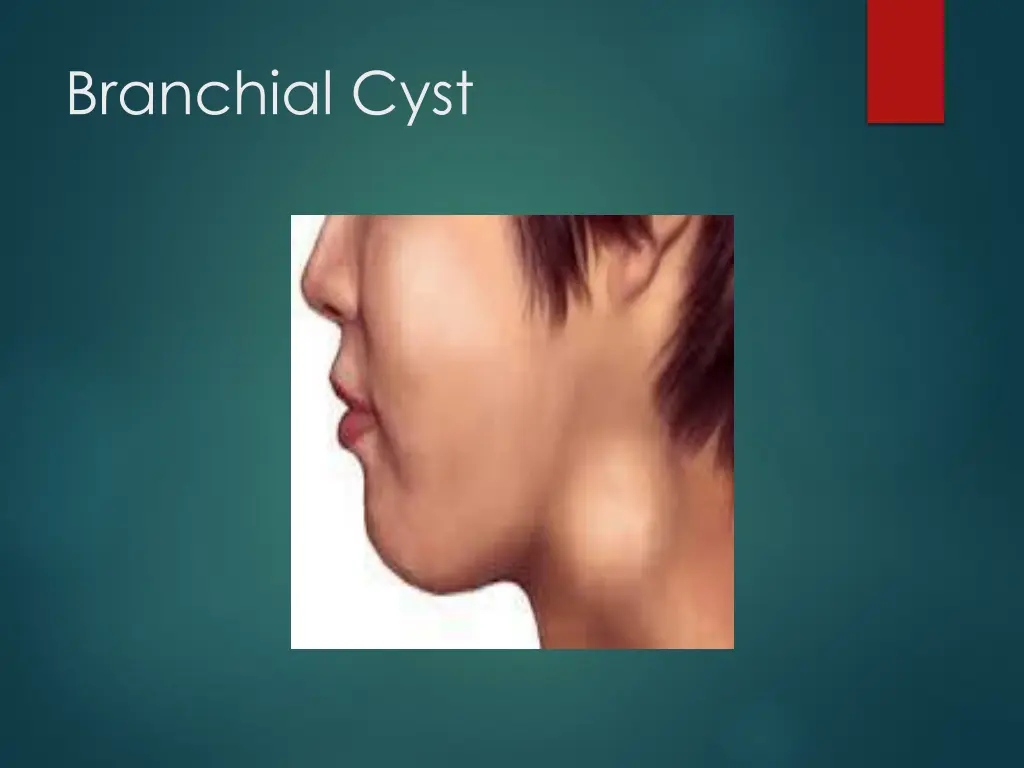 branchial cyst 3