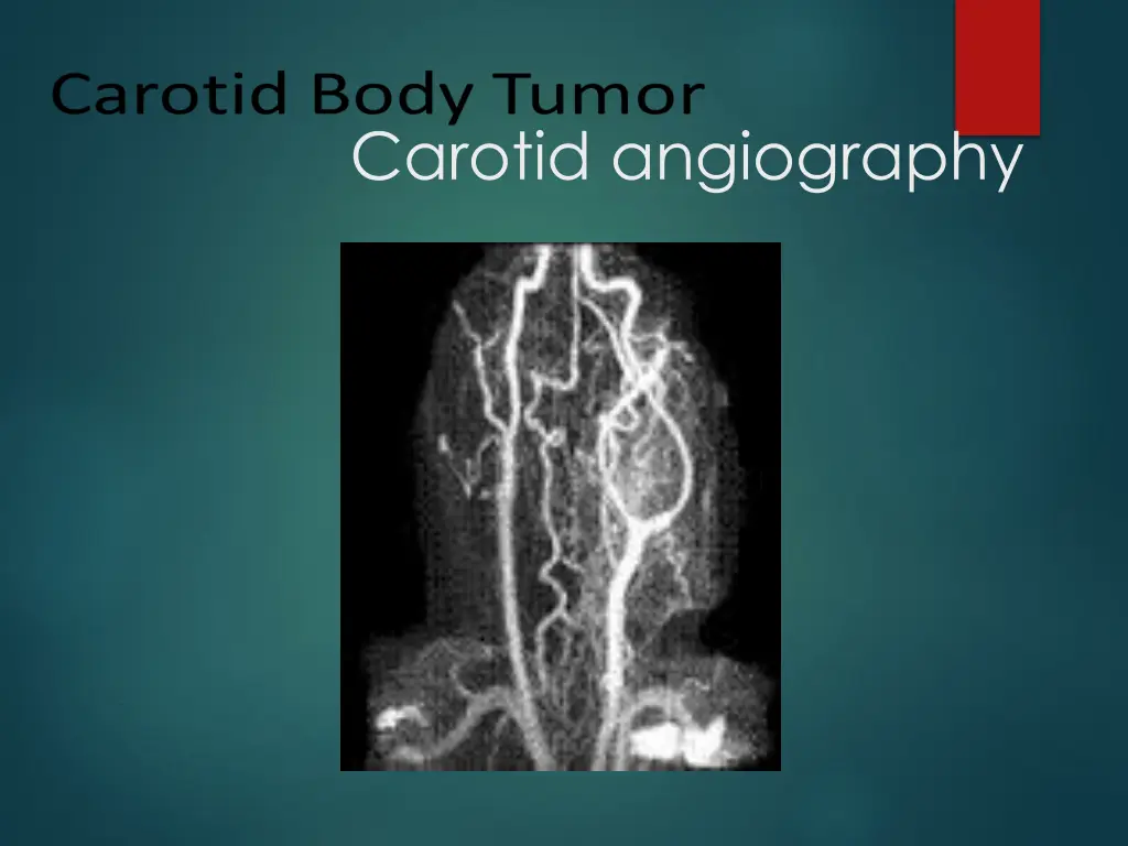 carotid angiography