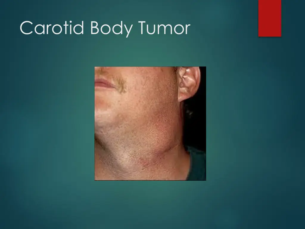 carotid body tumor