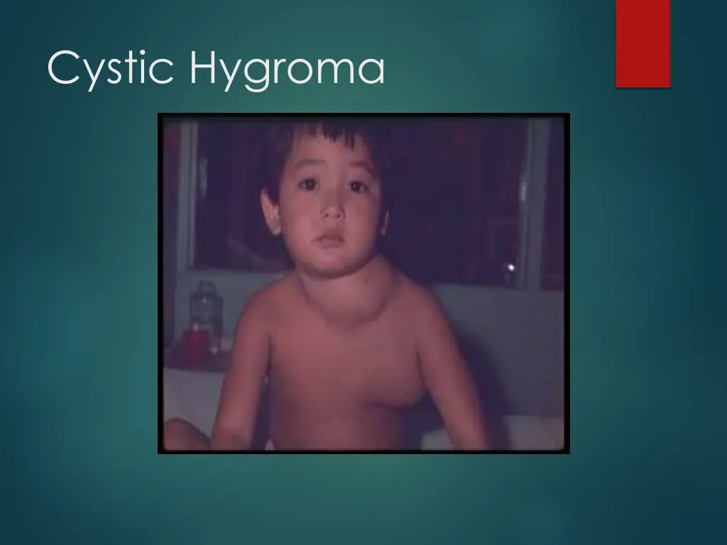 cystic hygroma