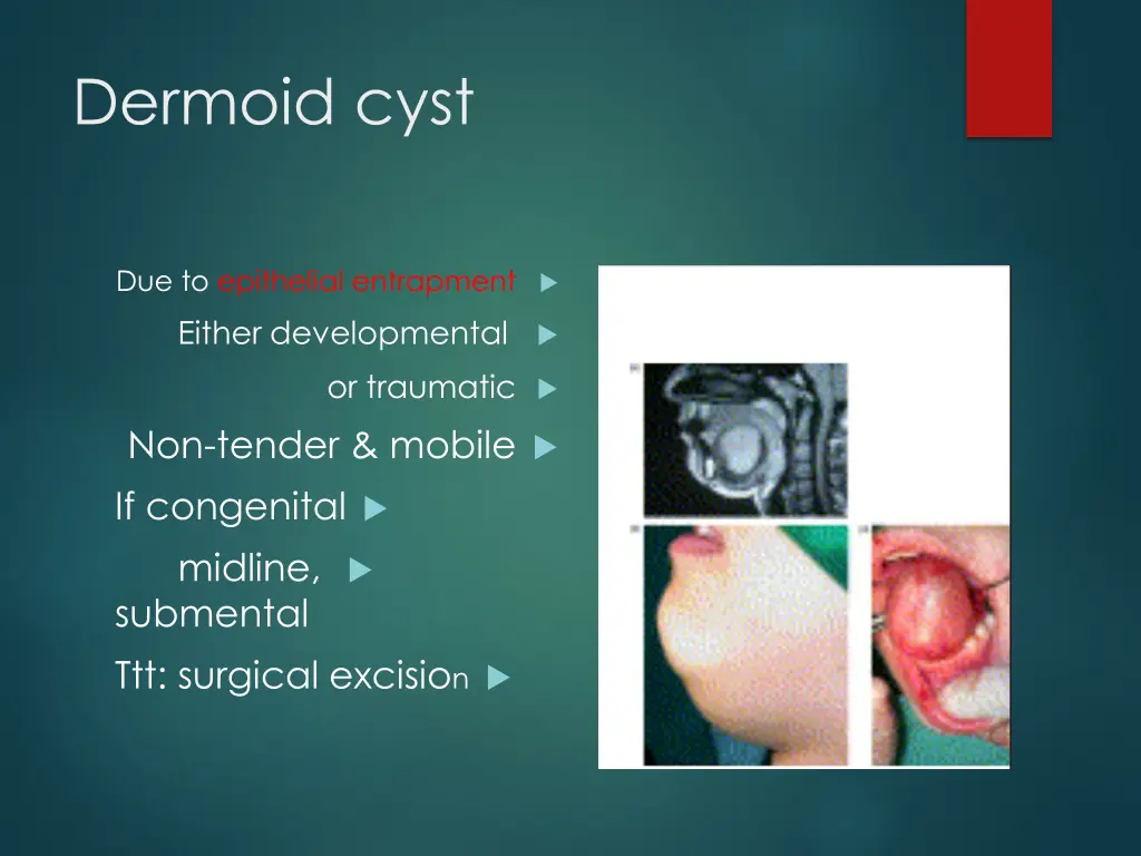 dermoid cyst