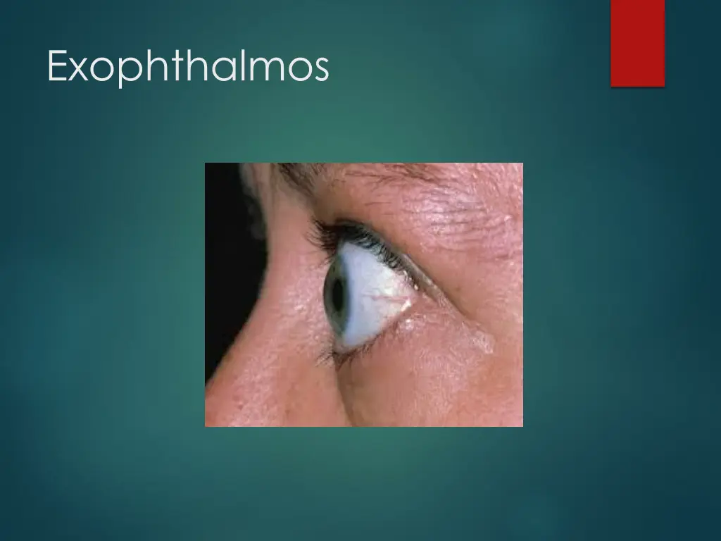 exophthalmos