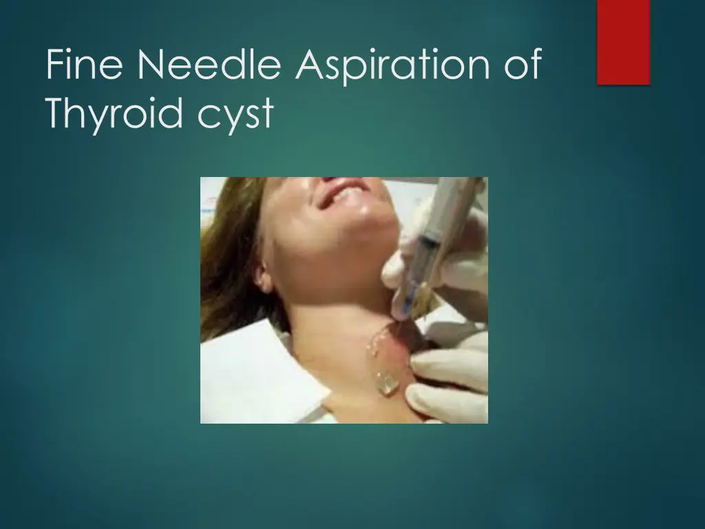 fine needle aspiration of thyroid cyst