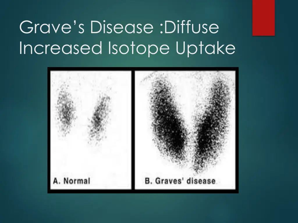 grave s disease diffuse increased isotope uptake