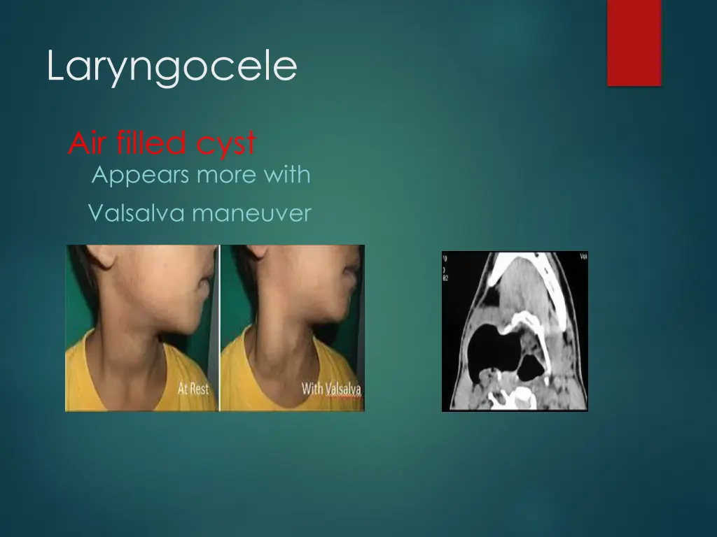 laryngocele