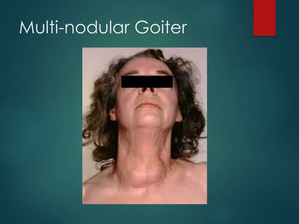 multi nodular goiter