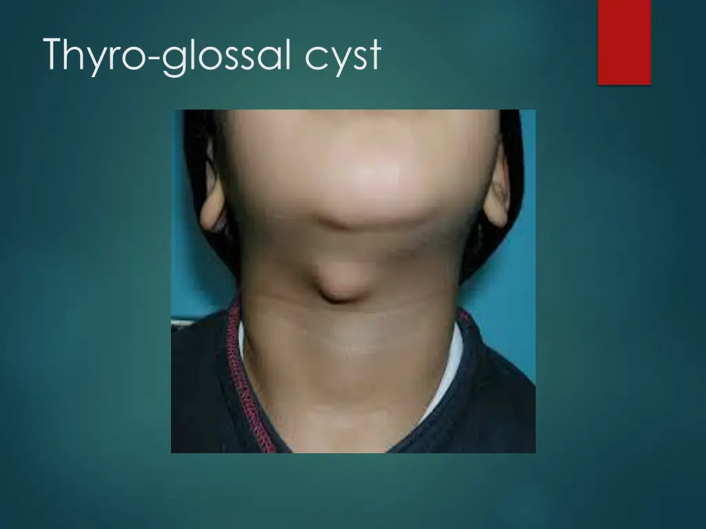 t hyro glossal cyst