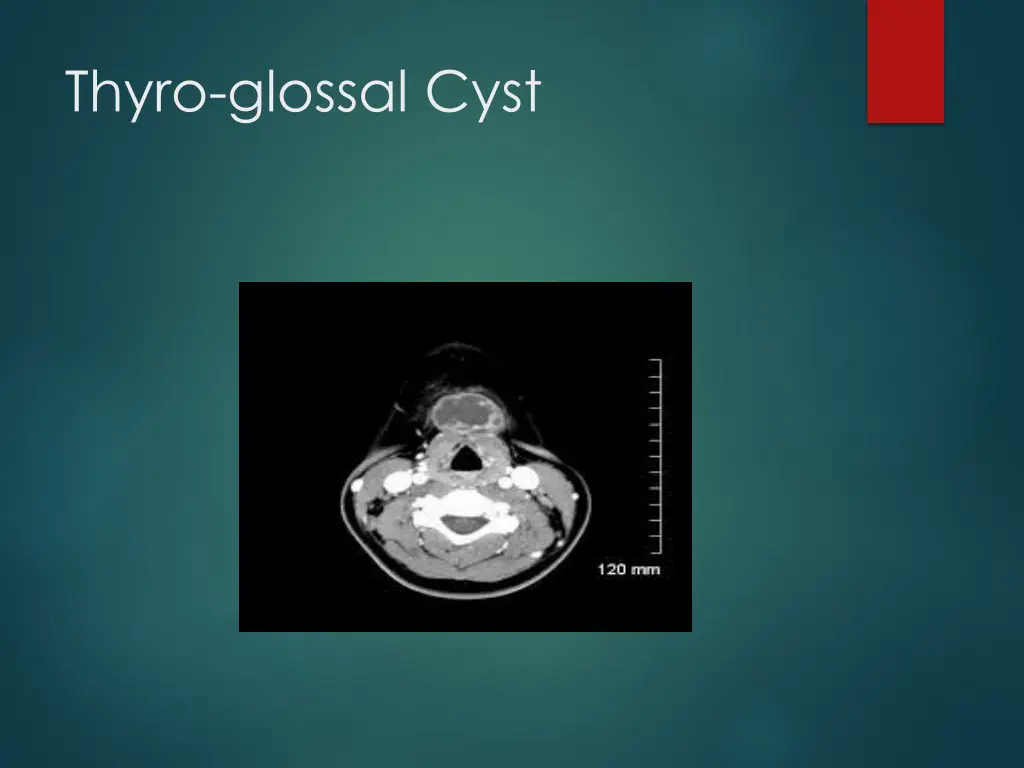 thyro glossal cyst 2