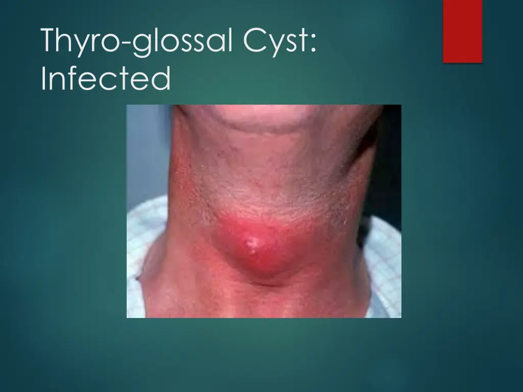 thyro glossal cyst infected