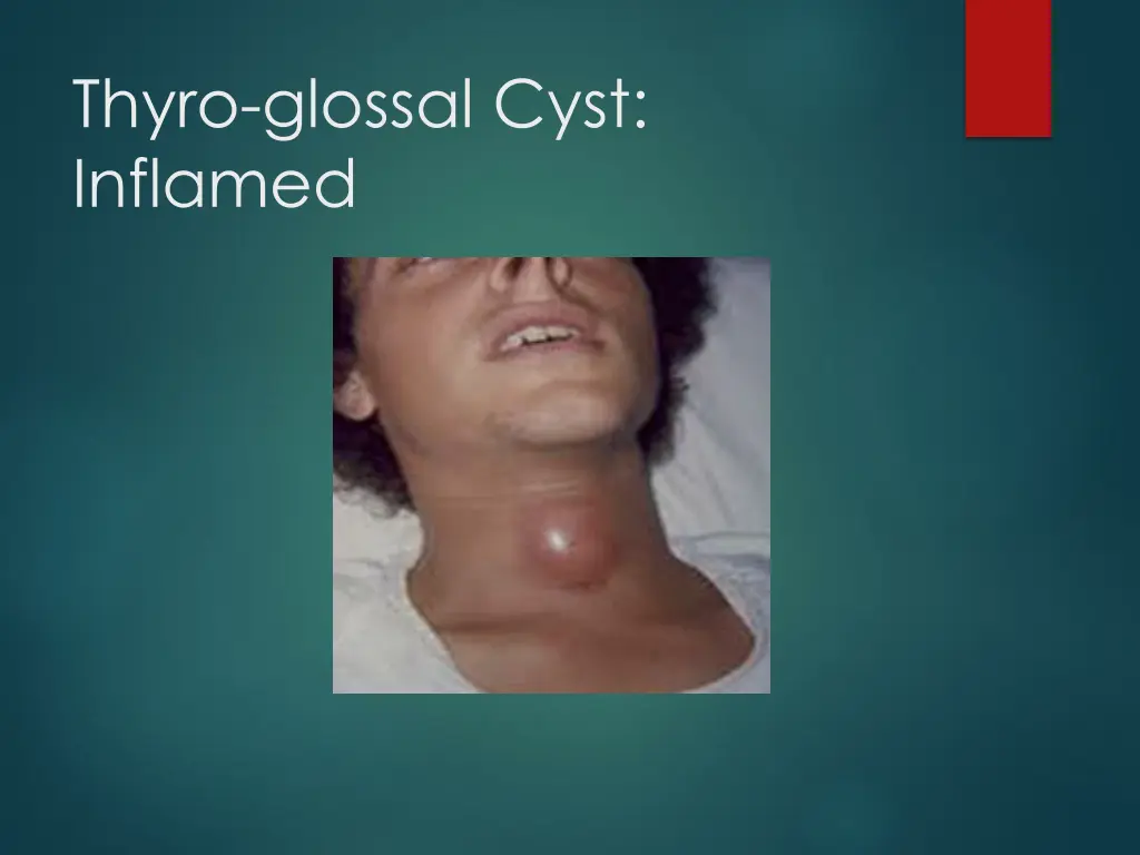 thyro glossal cyst inflamed