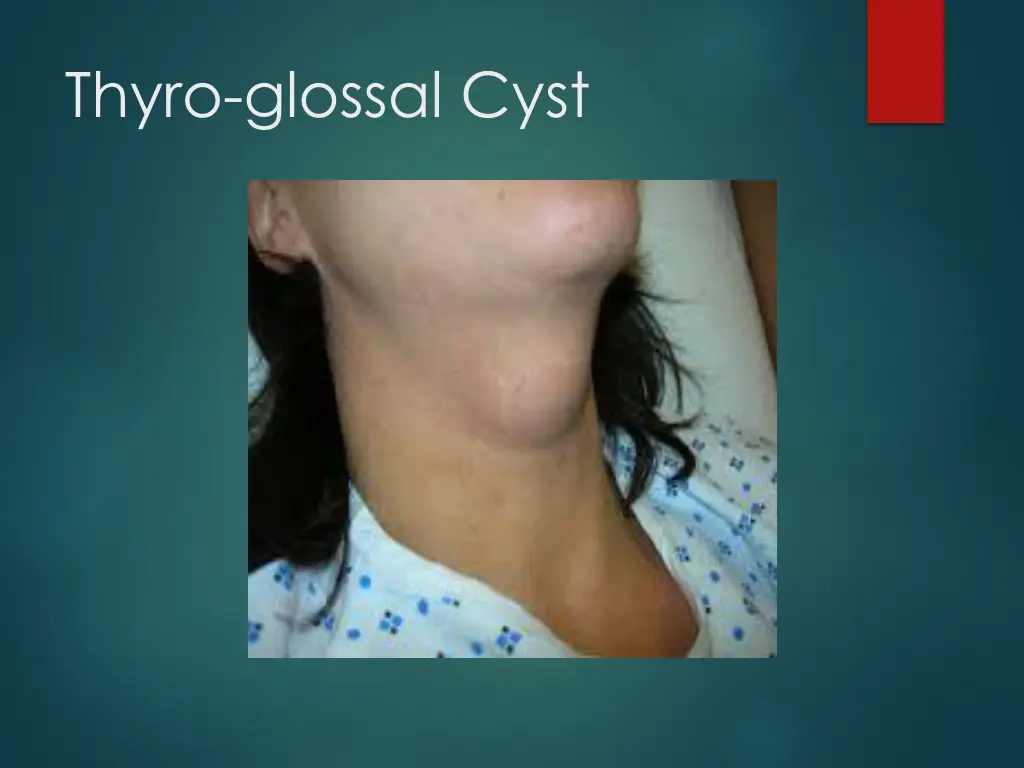 thyro glossal cyst