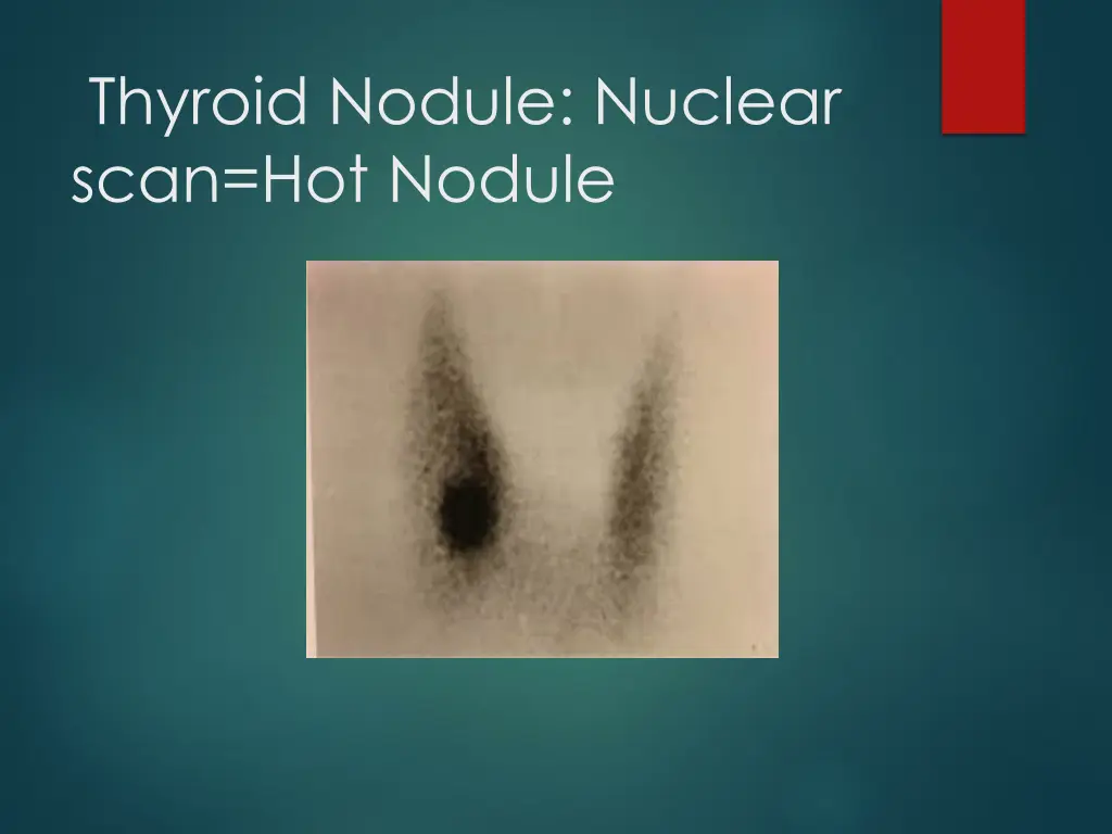 thyroid nodule nuclear scan hot nodule