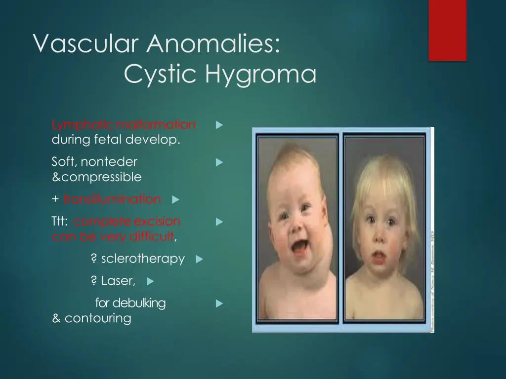 vascular anomalies cystic hygroma